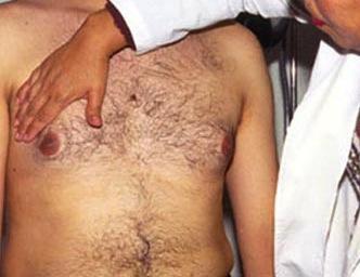 Cáncer de mama afectando a hombres y mujeres