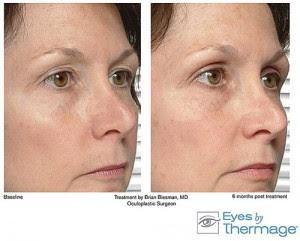 Radiofrecuencia en Centro Estética Leo.