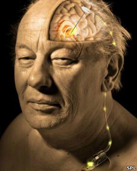 Marcapasos-cerebral-nuevo-enfoque-contra-el-Alzheimer121206180211_deep_brain_281x351_spl