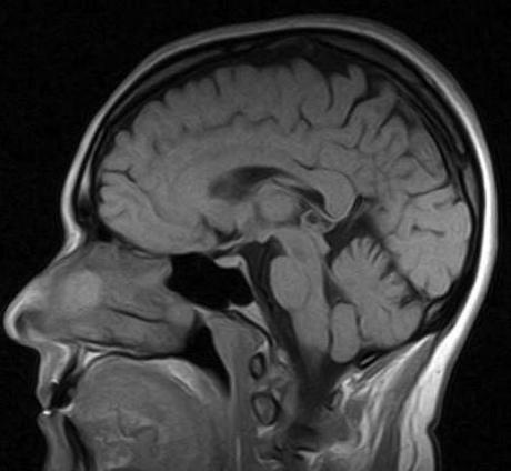 Nuevos hallazgos sobre la enfermedad de Alzheimer