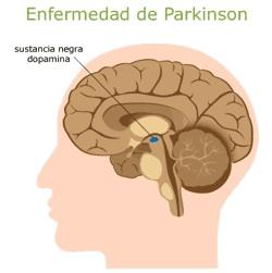 El sistema nervioso afectado por la enfermedad de Parkinson