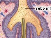 forúnculo tratamiento efectivo para evitar propagación