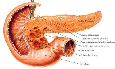 Las posibles causas para sufrir de una pancreatitis