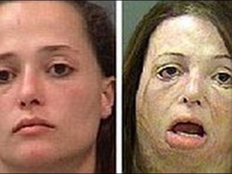 Así se ven los efectos de las metanfetaminas en el cuerpo humano