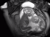 Pelea gemelos vientre madre VIDEOS