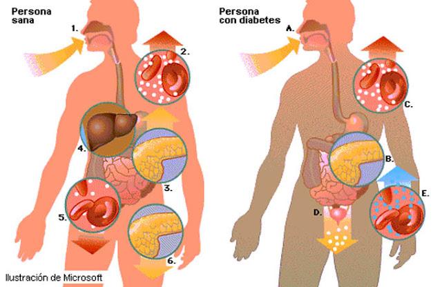 Que es la Diabetes