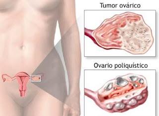 Qué son Ovarios Poliquísticos y cuál es el tratamiento