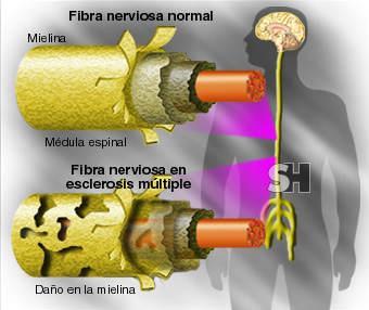 El aspecto más molecular de la esclerosis múltiple El aspecto más molecular de la esclerosis múltiple