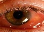 Nuestro afectado conjuntivitis