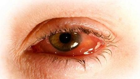 Nuestro ojo afectado por la conjuntivitis