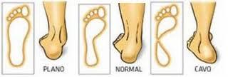 Qué es el pie plano y hasta que edad es normal