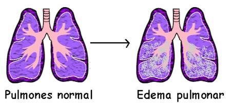 El edema agudo de pulmón como una de las enfermedades más mortales de hoy