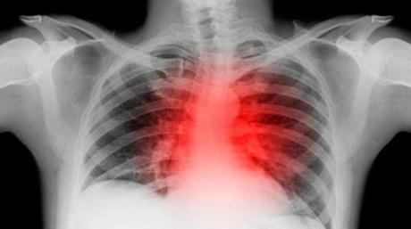 Se moría y le inyectaron alcohol puro para salvarle la vida - OTRAS NOTICIAS