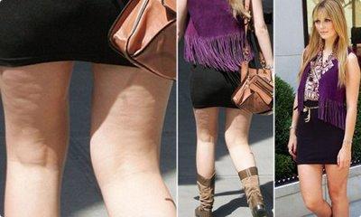 Como deshacerse rápido  de la celulitis en las piernas.