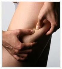 image ¿Que ocasiona la aparición de la celulitis?