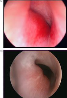 Hemangiomas infantiles y otros tumores vasculares: revisión sobre terminología, patogénesis y tratamiento. Consenso sobre el uso de propanolol. Hemangiomas infantiles y otros tumores vasculares: revisión sobre terminología, patogénesis y tratamiento. Consenso sobre el uso de propanolol.