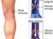 Curas naturales para varices