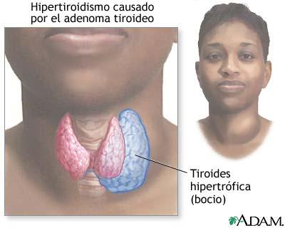 Curas naturales para el hipertiroidismo. Hierbas para hipertiroidismo