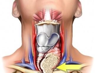 Diferentes formas de presentarse un cáncer de tiroides Diferentes formas de presentarse un cáncer de tiroides