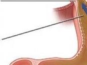 Consejos para controlar reflujo gástrico