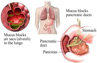 Tratamiento de la fibrosis quística. Objetivos y avances Fibrosis-quística