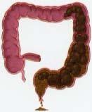 Un trastorno dramático en el niño, la incontinencia fecal