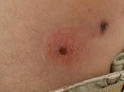 Mordeduras picaduras