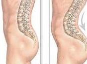 Objetivos pilates para hiperlordosis lumbar
