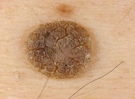 Vigilar las lesiones precancerosas de la piel