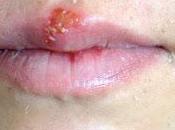 Herpes labial Aftas orales