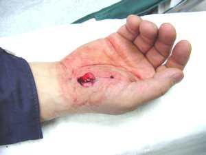 Prevenir el tétanos Prevenir el tétanos