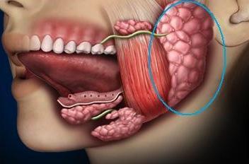 ¿Hay quienes puede afectar la parotiditis? parotiditis