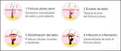 Acnexpert una solución al problema del acné