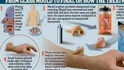 implantan nariz en brazo de paciente con cáncer