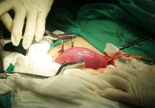 Suma Cuba más de cinco mil trasplantes renales