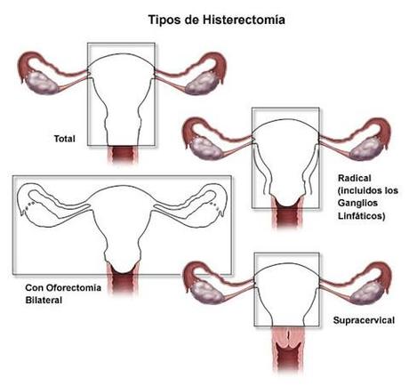Cuándo es aconsejable practicar la histerectomía Cuándo es aconsejable practicar la histerectomía
