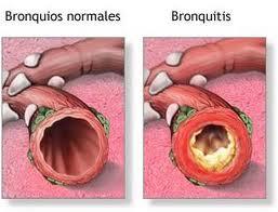 Que es la bronquitis aguda, causas, síntomas y tratamiento