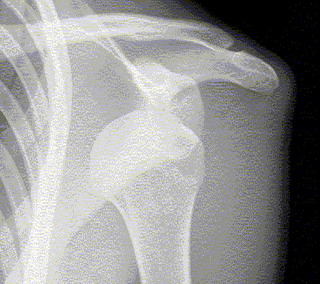 Luxación de Hombro (salido, afuera)