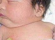 Bebés nacidos cesárea propensos tener sobrepeso