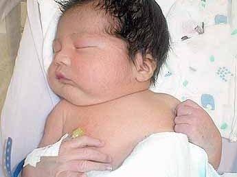 Bebés nacidos por cesárea más propensos a tener sobrepeso