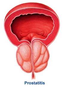 prostatitis