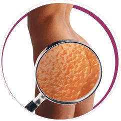 Armas secretas para combatir la celulitis