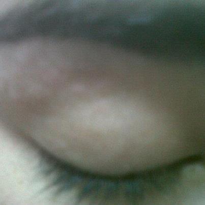 Foto: Caso 56. Que lesiones tiene esta persona en los parpados ?