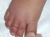 Síndrome torniquete pene. horrible caso niño enuresis nocturna (mojar cama noche)