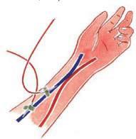 Situaciones que se pueden presentar en una fístula