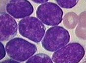 Descubierto 'talón Aquiles' leucemia linfoide