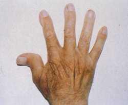 artritis reumatoidea