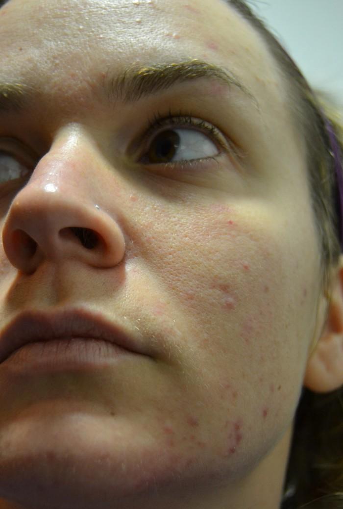Belleza Facial: Limpieza Facial Diaria & Combatir Brote Acné