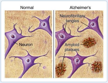 Marcas del Alzheimer