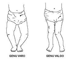 El dolor de espalda debido a las piernas arqueadas